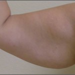 brazo antes