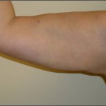 brazo después