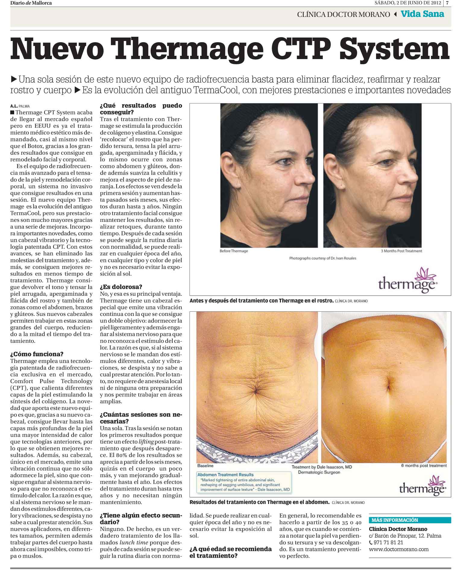 Nuevo Thermage CTP System