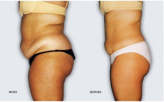 Ultrashape. Moldeado corporal sin cirugía