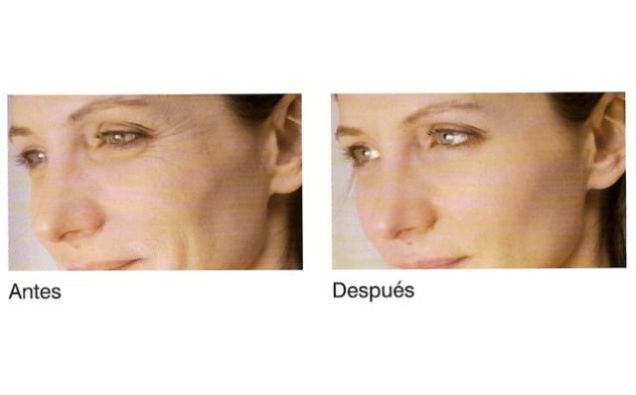 Tratamiento Facial