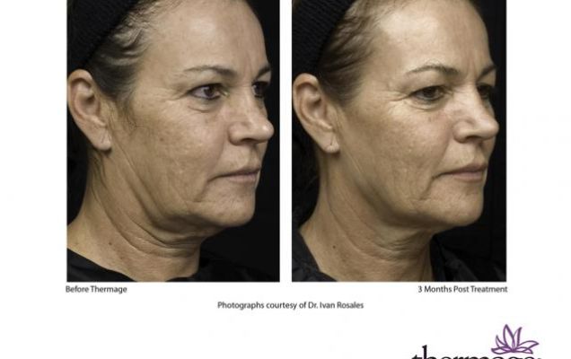 thermage_facial_tensado piel_lifting